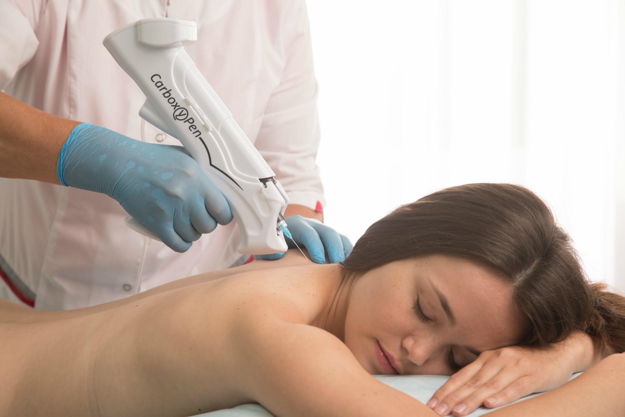 Карбокситерапия